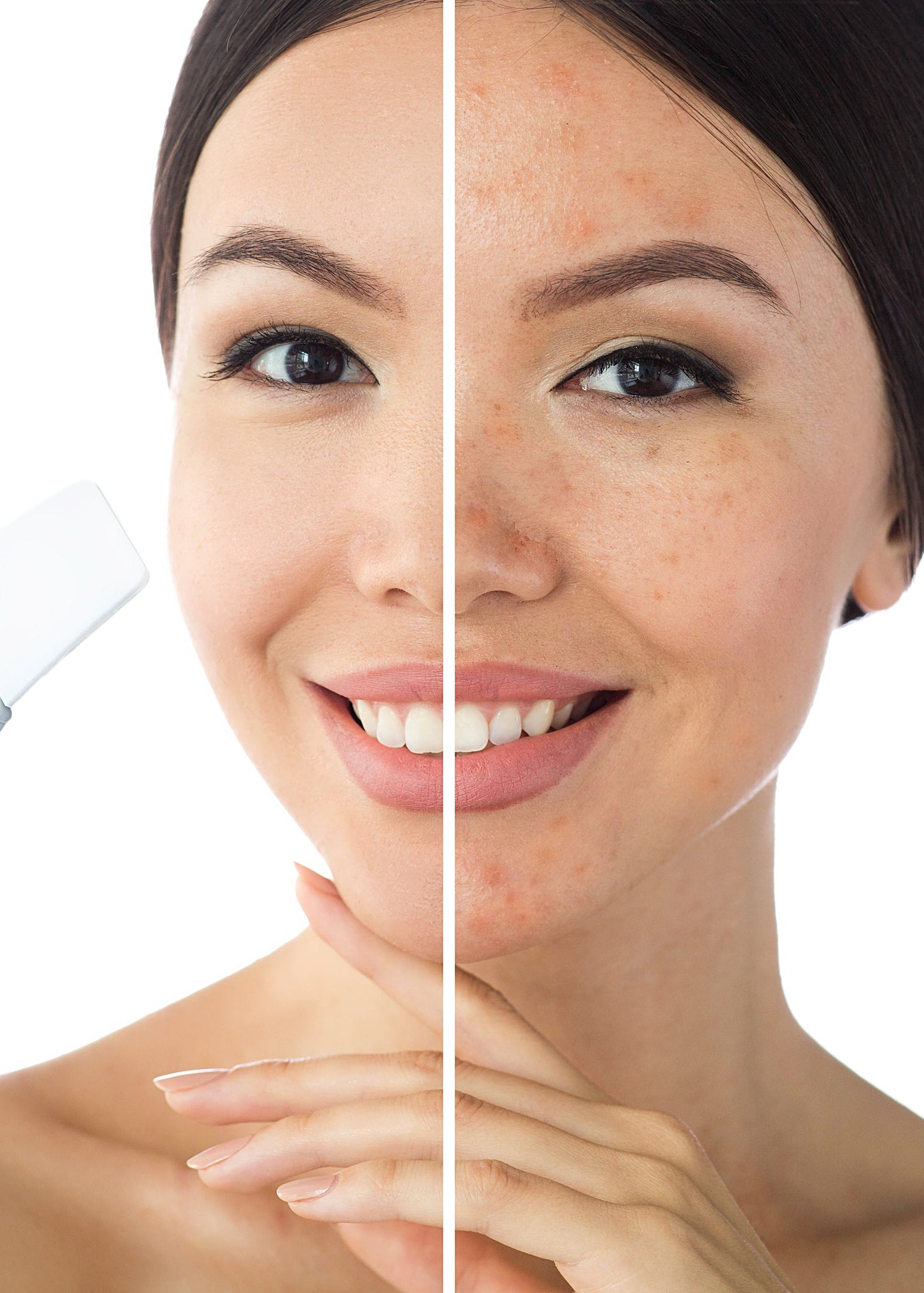 Vhi Progressive Peel: 30 to 45mins